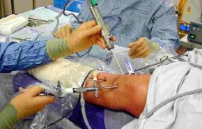 دراسة: جراحة الركبة تقلل مستوى اداء الرياضيين