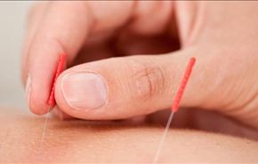 باحثة إيرانية تكشف عن آلية عمل طب الوخز بالإبر