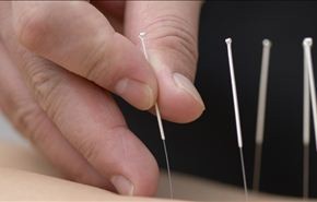 الوخز بالإبر علاج فعال ضد الاكتئاب