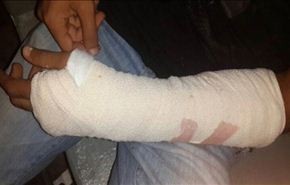 مرتزقة المنامة تعتدي على طفل وتتسبب بكسر في يده