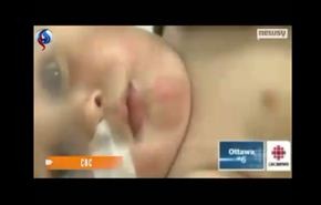 شاهد..رضيع لايستطيع فتح فمه ويتغذى عبر انفه!