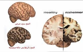 كيف يدمر مرض الزهايمر الدماغ‏؟