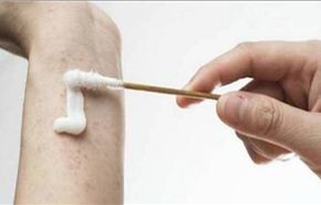 5 مكونات طبيعية لعلاج لدغ البعوض