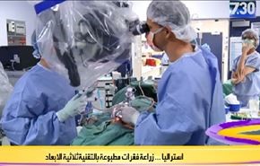 استراليا.. زراعة فقرات مطبوعة بالتقنية ثلاثية الابعاد