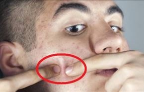 ما المضر أكثر.. إزالة البثور يدوياً أم تركها؟