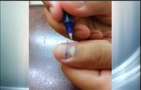 بالفيديو.. طريقة غريبة لعلاج ألم الأسنان في أقل من 30 ثانية!