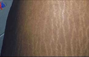 تخلصوا من علامات تمدد الجلد والندوب المزعجة بمكون واحد فقط!