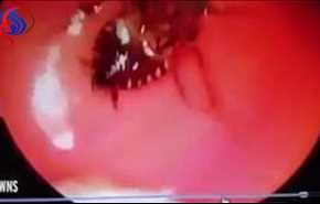 شاهد بالفيديو.. لحظة إزالة صرصور حي من جمجمة سيدة