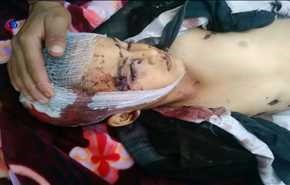 استشهاد 5 بينهم طفل وجرح 8 بانفجار قنبلة في مذيخرة إب