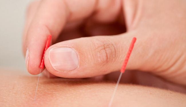 باحثة إيرانية تكشف عن آلية عمل طب الوخز بالإبر