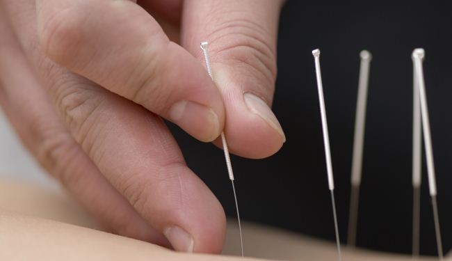 الوخز بالإبر علاج فعال ضد الاكتئاب