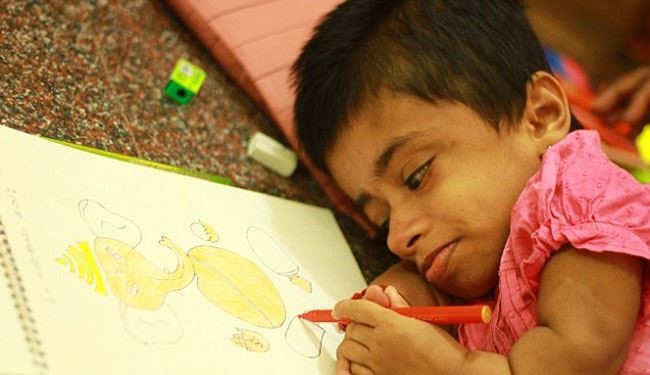 دختر 19 ساله هندی در بدن کودک دوساله