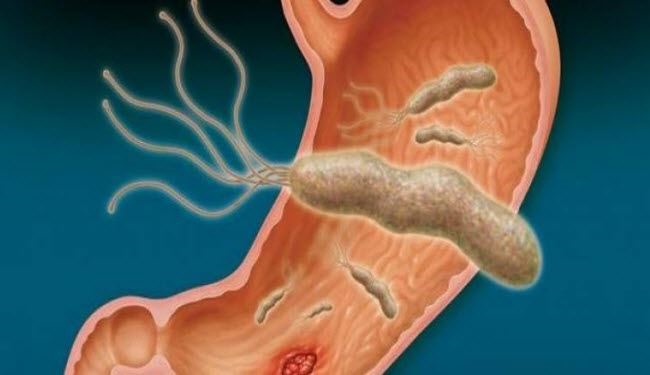أقوى علاج طبيعي لجرثومة المعدة.. دون تكاليف!