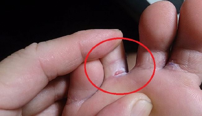 وصفة مذهلة للتخلص من فطريات أصابع القدم