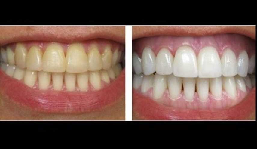 تخلص من تكلس الأسنان ورائحتها بهذه الخلطة السهلة!