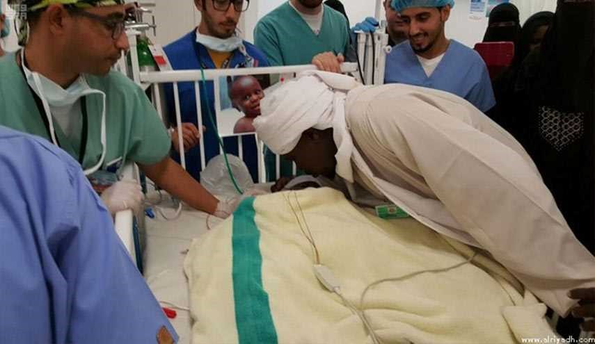 بالصور.. نجاح عملية فصل التوأم السوداني 