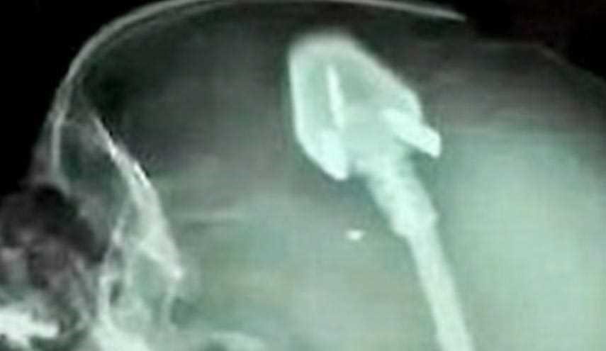 فرو رفتن سه شاخه برق در سر کودک 2 ساله+عکس