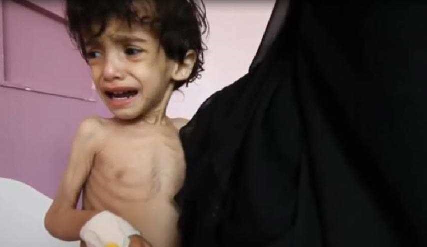 جوع أطفال اليمن يفضح نفاق الغرب المتباكي على حلب