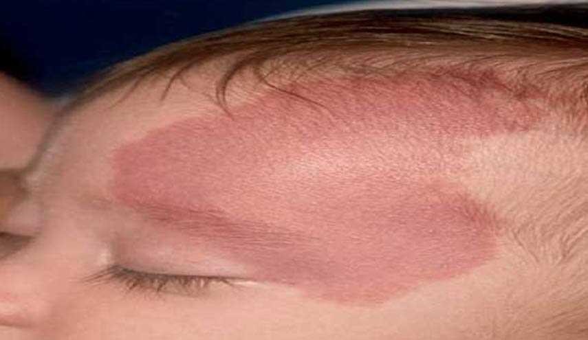 هل صحيح أن ‏الحامل‬ إذا اشتهت طعام ولم تأكله فإنه يظهر على شكل ‏وحمة؟!