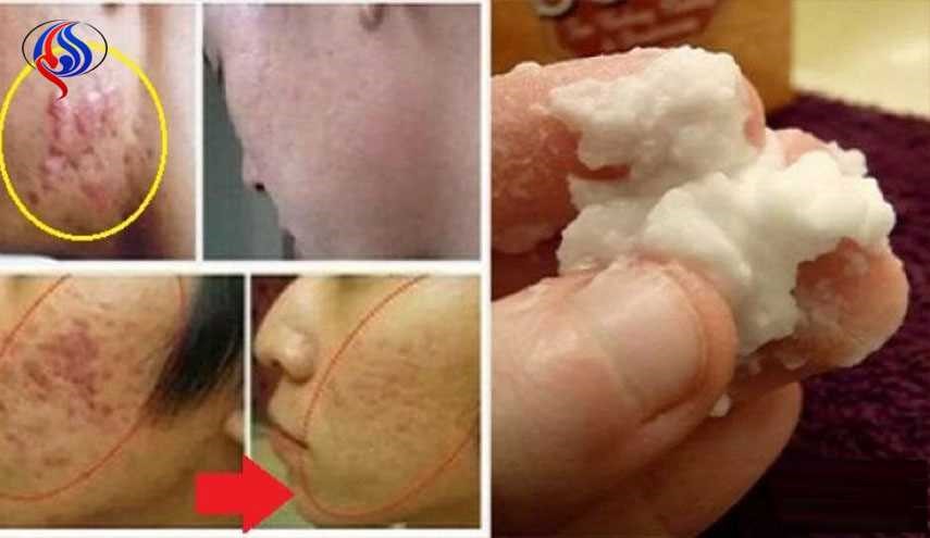 إليك هذه الخلطة المنزلية للتخلص من حب الشباب نهائياً!