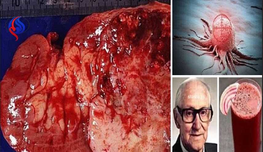 الخلايا السرطانية تموت في 42 يوماً بسبب هذا العصير فقط!