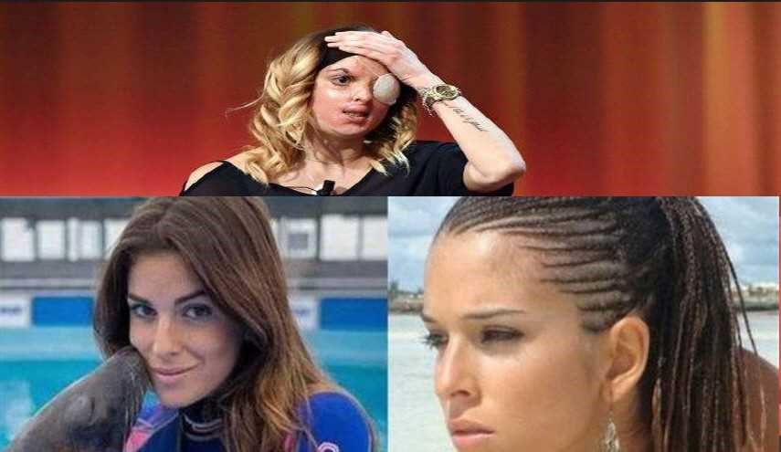 ملكة جمال إيطاليا التي حرقها حبيبها بـ