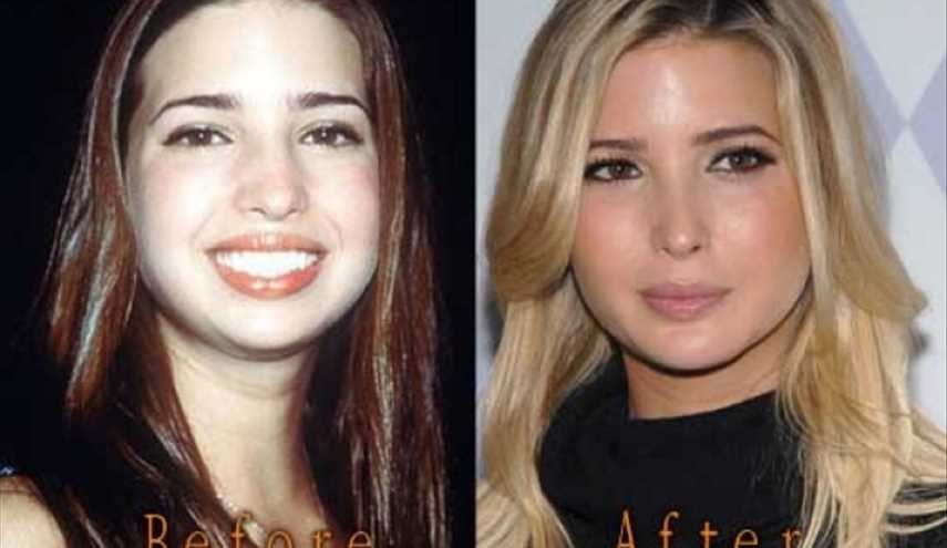 بالصور.. لن تصدقوا كيف كانت ايفانكا ترامب قبل عمليات التجميل!