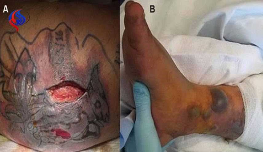 فاجعة مروعة... وضع وشم على رجله، وبعد 5 أيام حدثت الكارثة!