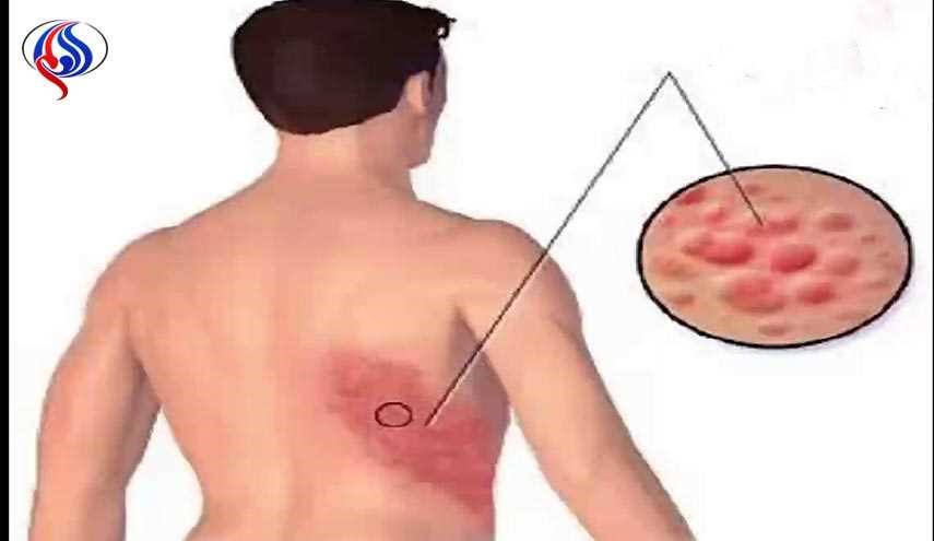 مرضى الحزام الناري معرضون للإصابة بأزمة قلبية أو سكتة دماغية