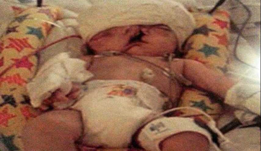 بعد أن وُلد بوجهين وعانى الأمرين .. هذا ما حصل بعد 13 عاما!