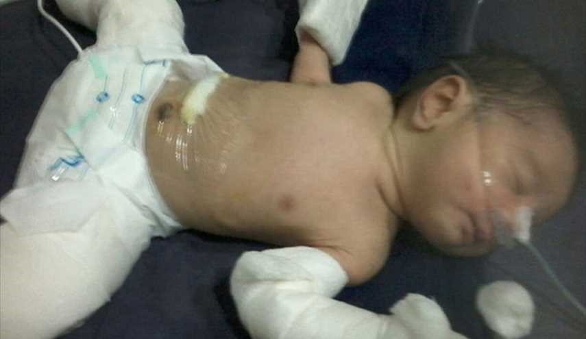 ولادة طفل في الهند حامل بأخيه التأم