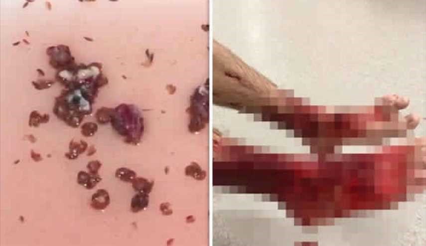 مروع : مخلوقات بحرية تلتهم سيقان المصطافين في أستراليا !!