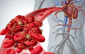  تخثر الدم.. اسبابه وعلاجاته