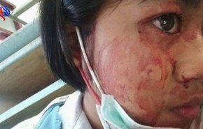 حالة مرضية تجعل شابة تتعرق دما !