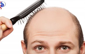ابتكار مستحضر جديد يقضي على الصلع