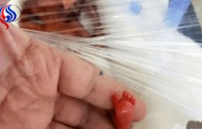 الرضيعة المعجزة.. أخف مولودة بالعالم تنجو من الموت!