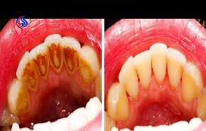 شاهد.. مفاجأة ازالة رواسب الأسنان بـ5 دقائق فقط، دون مراجعة الطبيب!
