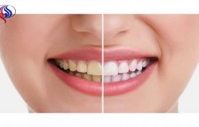 علاج جديد يقضي على تسوس الأسنان