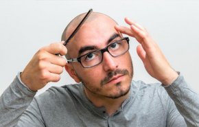 هذا هو علاج الصلع الوراثي