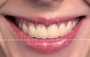 ما هو التصميم الرقمي للابتسامة؟ 