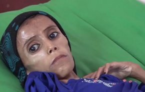 هذا ما فعله العدوان السعودي بالطفلة فاطمة !