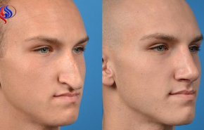 تقنية مذهلة لتجميل الأنف خلال 5 دقائق ودون جراحة!