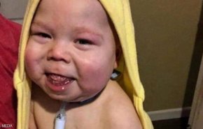 طفل ينطق مجددا بعد قطع جزء كبير من لسانه!!