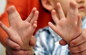 عملية جراحیة ناجحة لإزالة الأصابع الزائدة في يدي طفلة