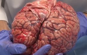 لأول مرة في إيران... مختصون يصنعون جهازاً طبياً لتحفيز للدماغ