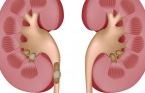 علاج حصى الكلى بـ 8 وصفات منزلية سهلة جداً 