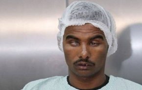 3 أشقاء يستعيدون بصرهم بعد فقدانه 30 عامًا