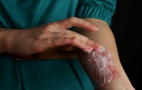 معجون الأسنان و...أخطاء نرتكبها بالإسعافات الأولية لمعالجة الحروق!