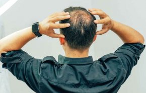 الكشف عن علاج بسيط وفعال لمشكلة الصلع