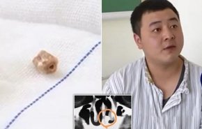 صدق أو لا تصدق.. الأسنان قد تنمو فى الأنف والأذن